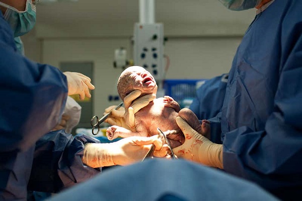 Study: Why C-section babies are at risk of certain diseases