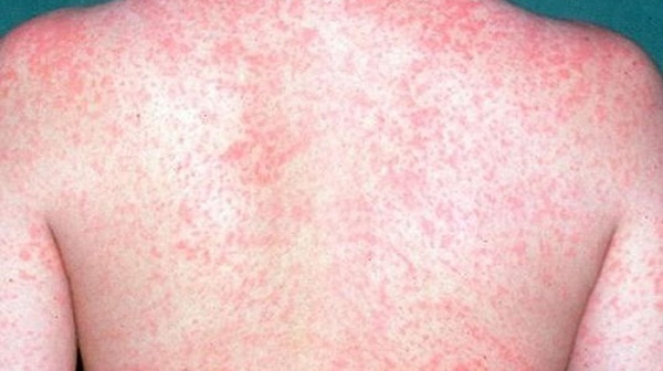 Study: Measles makes your body forget how to fight other diseases