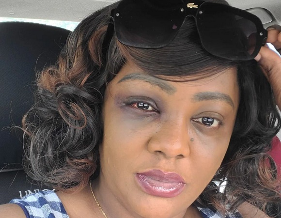 Helen Paul: How I suffered head injury after car accident